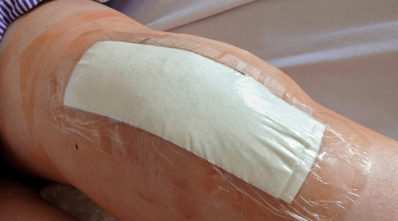 11 Easy Steps to Use a Wedge Pillow After Knee Replacement